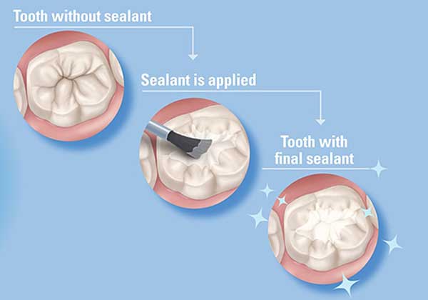Dental Sealants